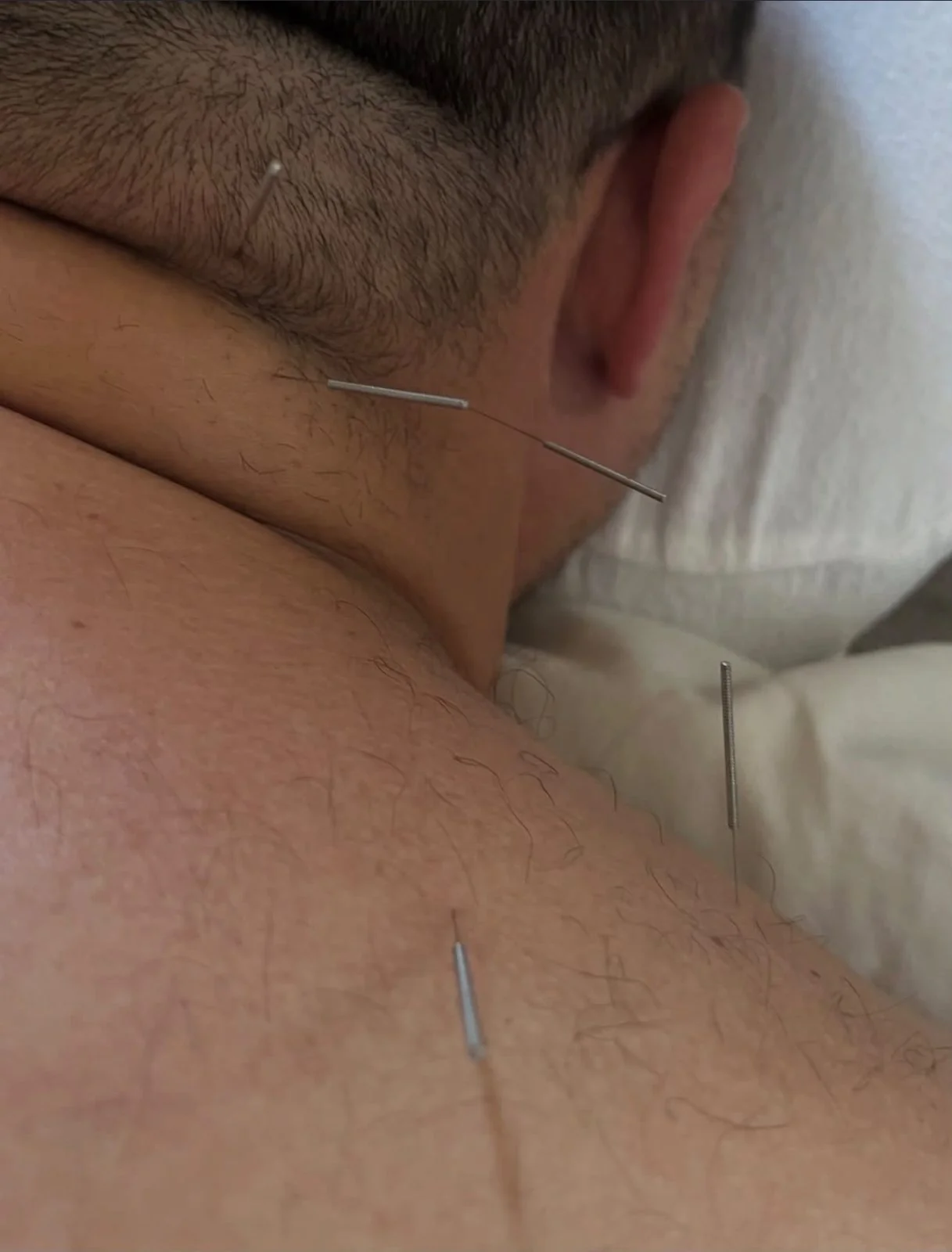Acupuncture treatment on the neck and upper back