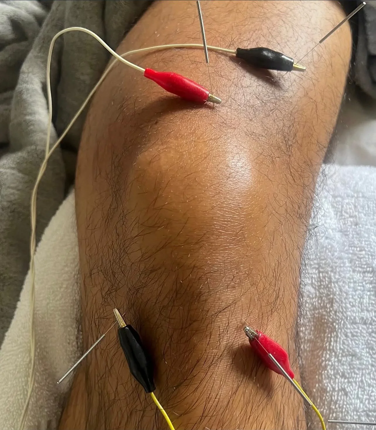 Acupuncture treatment around the knee with connected leads