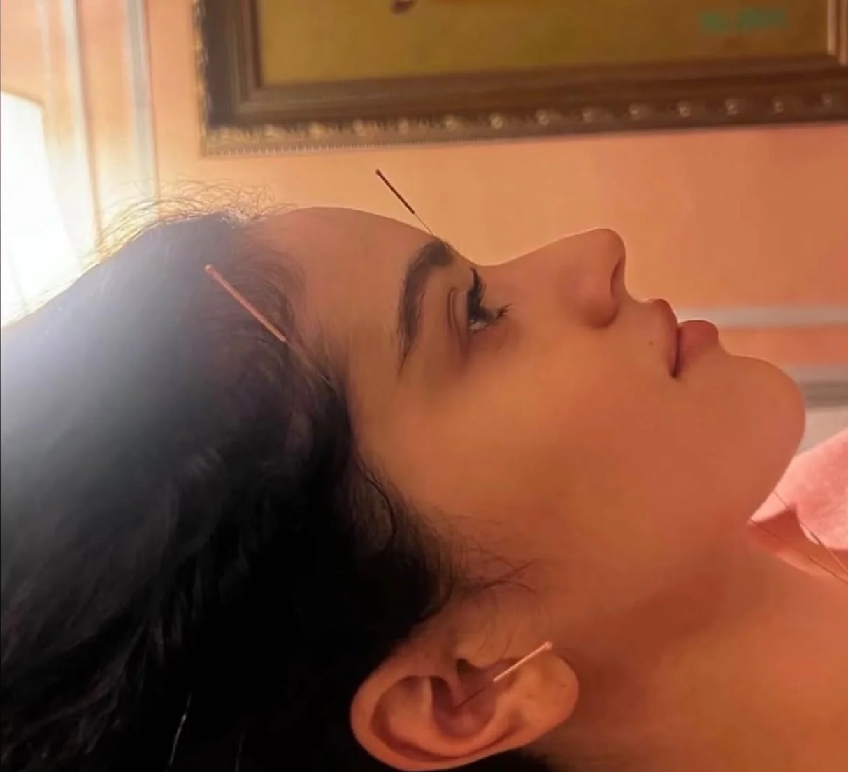 Facial acupuncture treatment at Toronto Body Mechanic