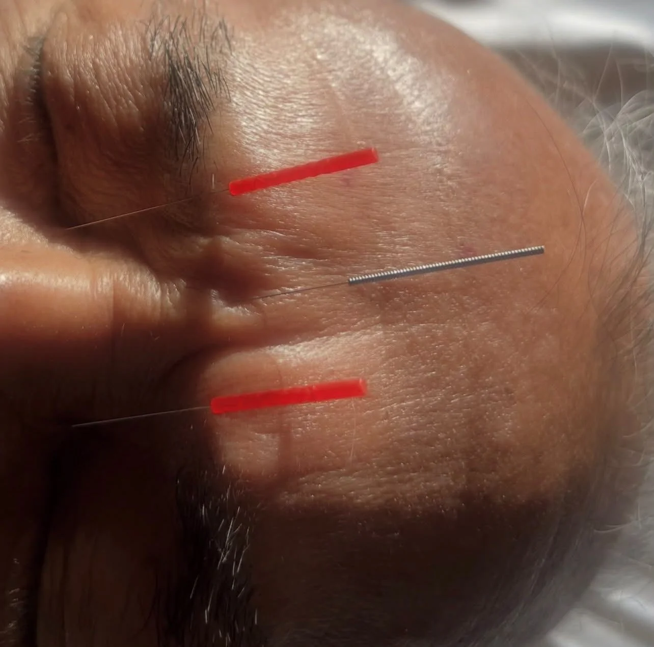 Close-up of facial rejuvenation acupuncture treatment